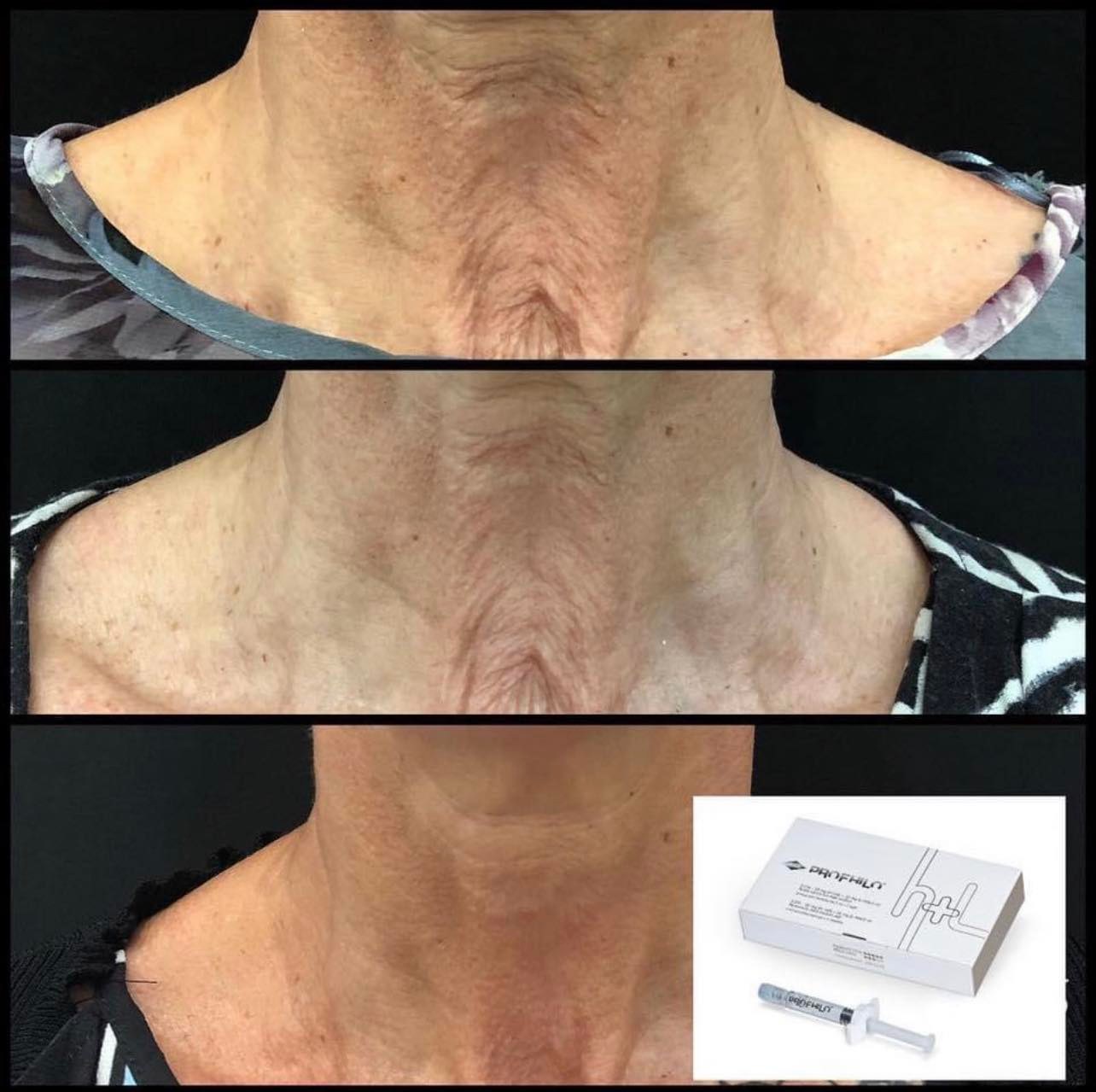 💉 P R O F H I L O 💉 ⠀⠀⠀⠀⠀⠀⠀⠀⠀ Profhilo is a pure Hyaluronic Gel ...