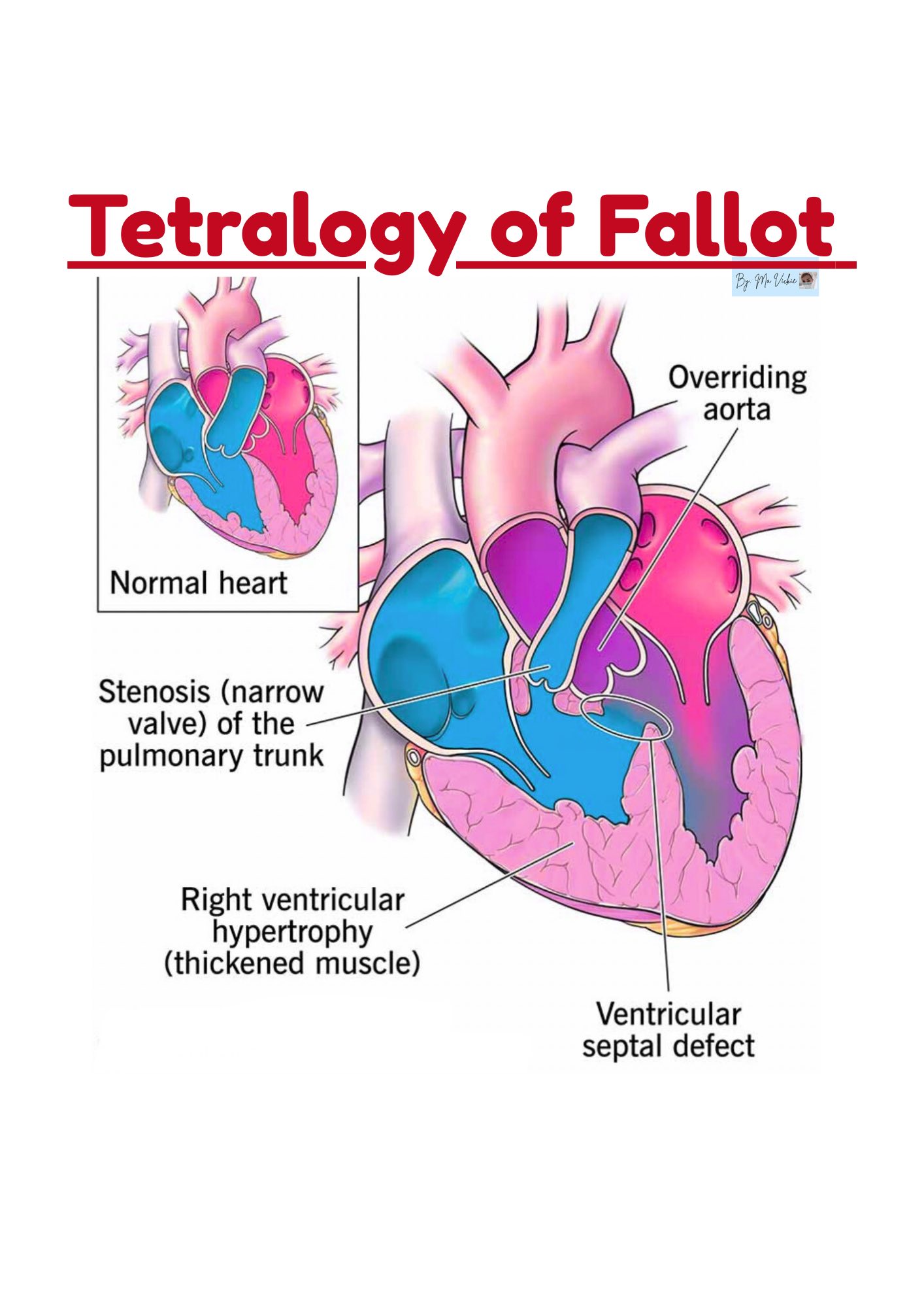 Ma Vickie - Understanding Tetralogy of Fallot🫀🧐🩺👇👇👇... | Facebook