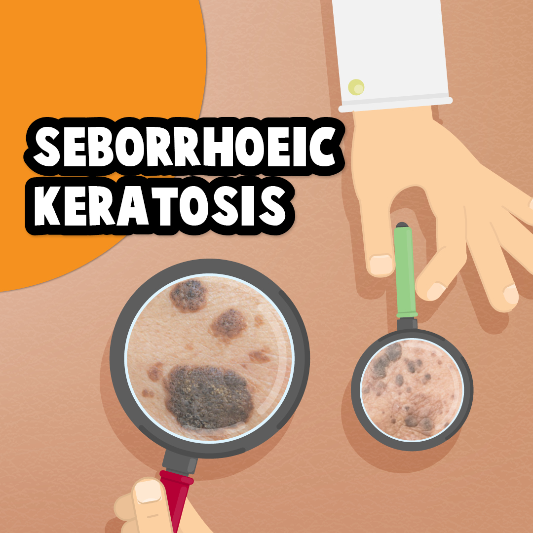 North Queensland Skin Centre - Seborrhoeic keratosis are also known as ...