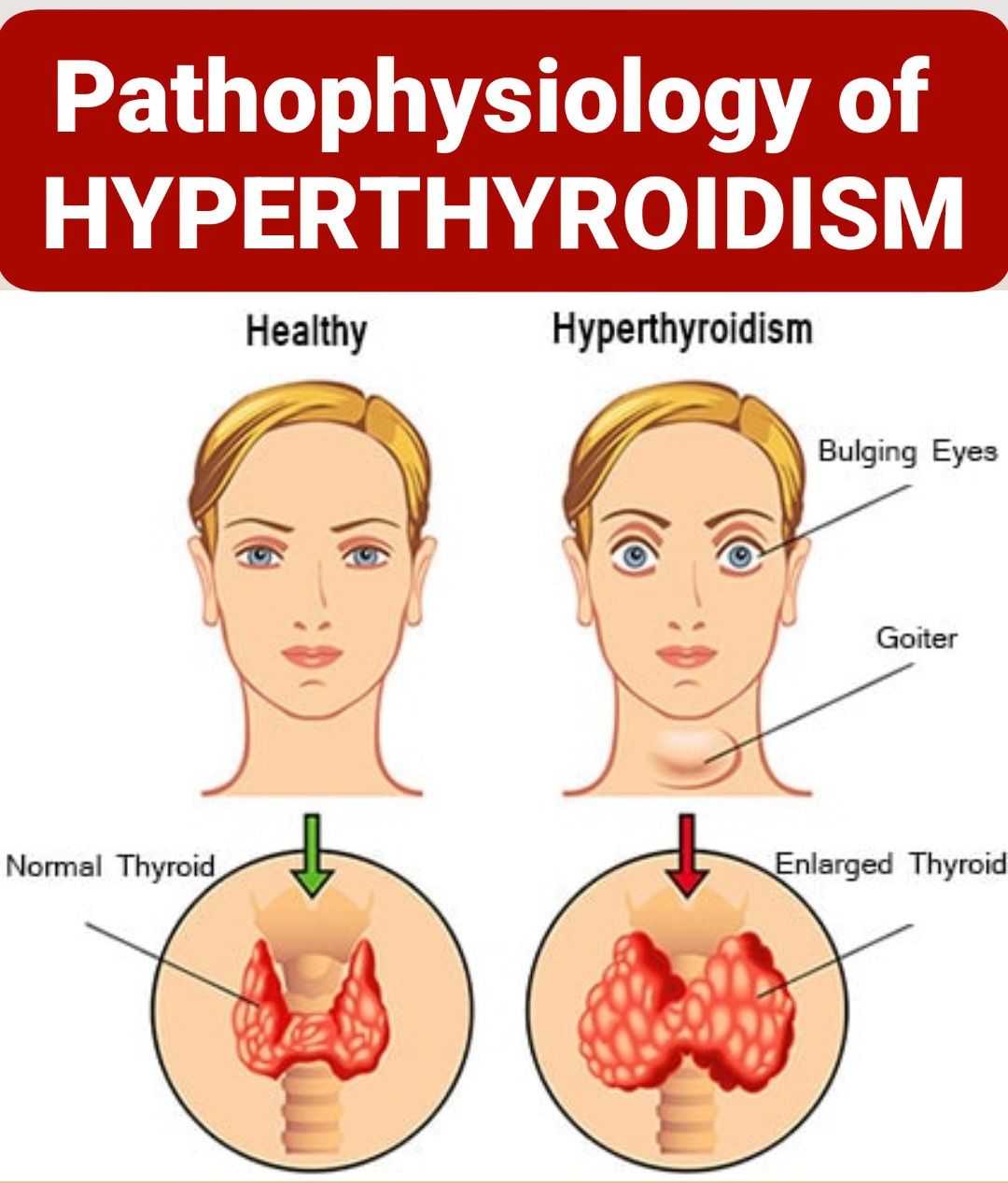glutathione for graves' disease Thyrotoxicosis: Recognizing a High-Risk Endocrine State Thyrotoxicosis is caused by excess circulating thyroid hormones (T3/T4), with presentations ranging from subtle asymptomatic cases to life-threatening thyroid storm. The AKU Manual of Clinical Knee injuries usually do Color:Oasis Category_Shop By Goal/Liver Health & Detoxification