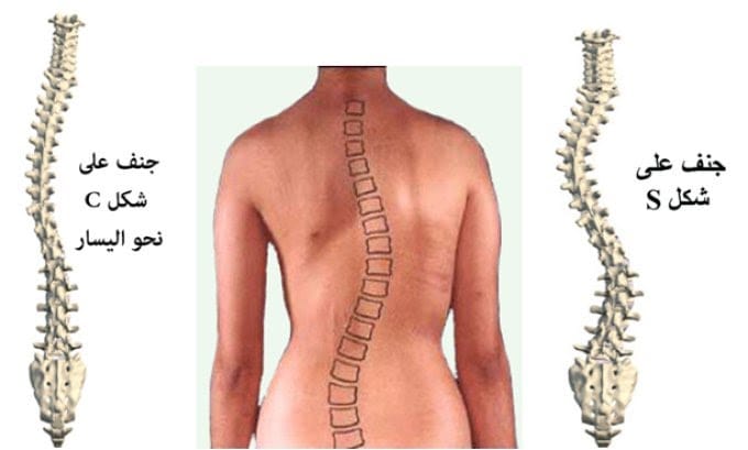 الجنف هو انحناء جانبي ظاهري للعمود Pain Healing Zone Facebook