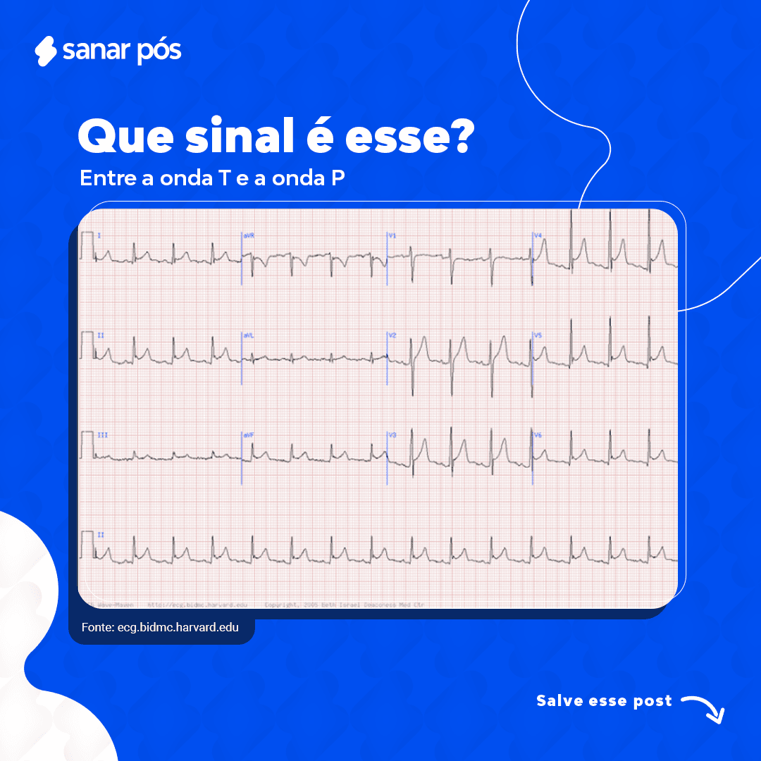 Pericardite Ecg Acute Pericarditis: Electrocardiogram JETem