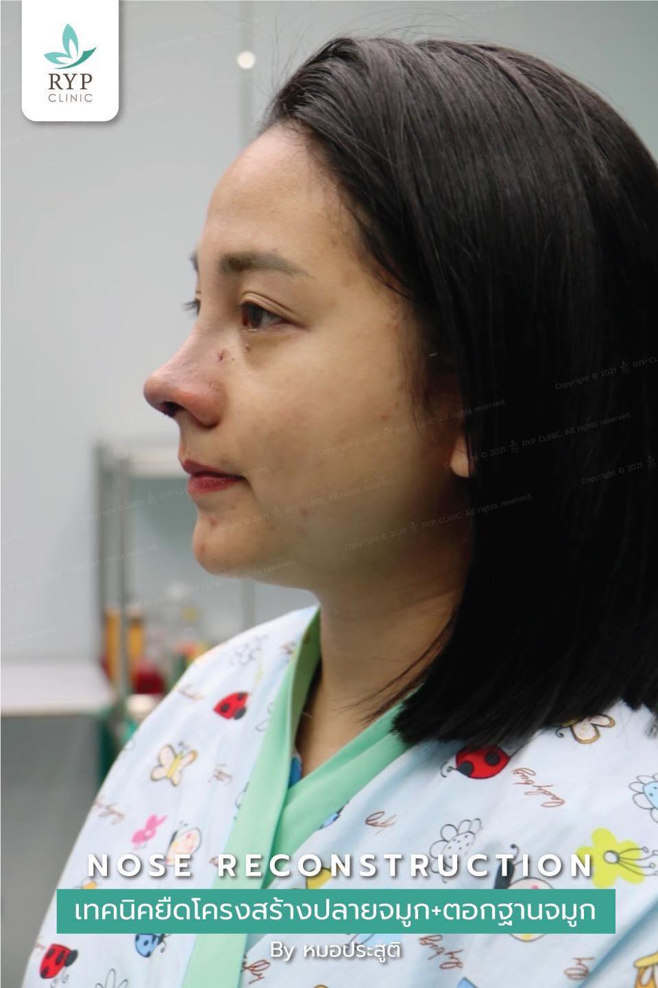 👃🏻🥰Nose... - รินทร์ญาพัส คลินิก Rinyaphat Clinic - RYP | Facebook