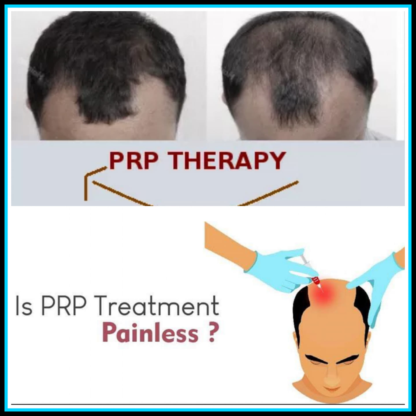 Shah's Hair Transplant & Skin Clinic - ️What is PRP.. Always remember ...