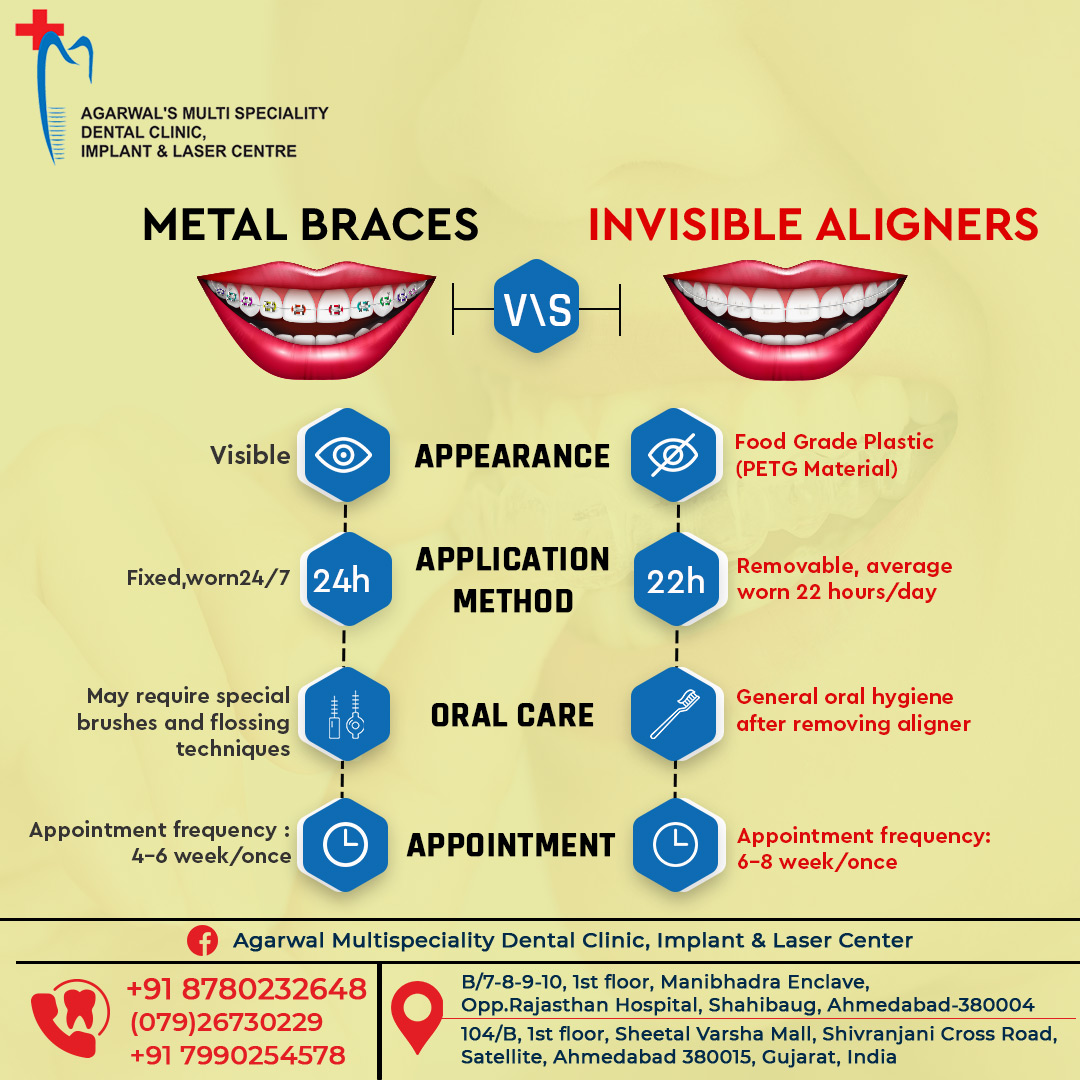 Have a look at the key differences between Metal Braces v/s Invisible ...