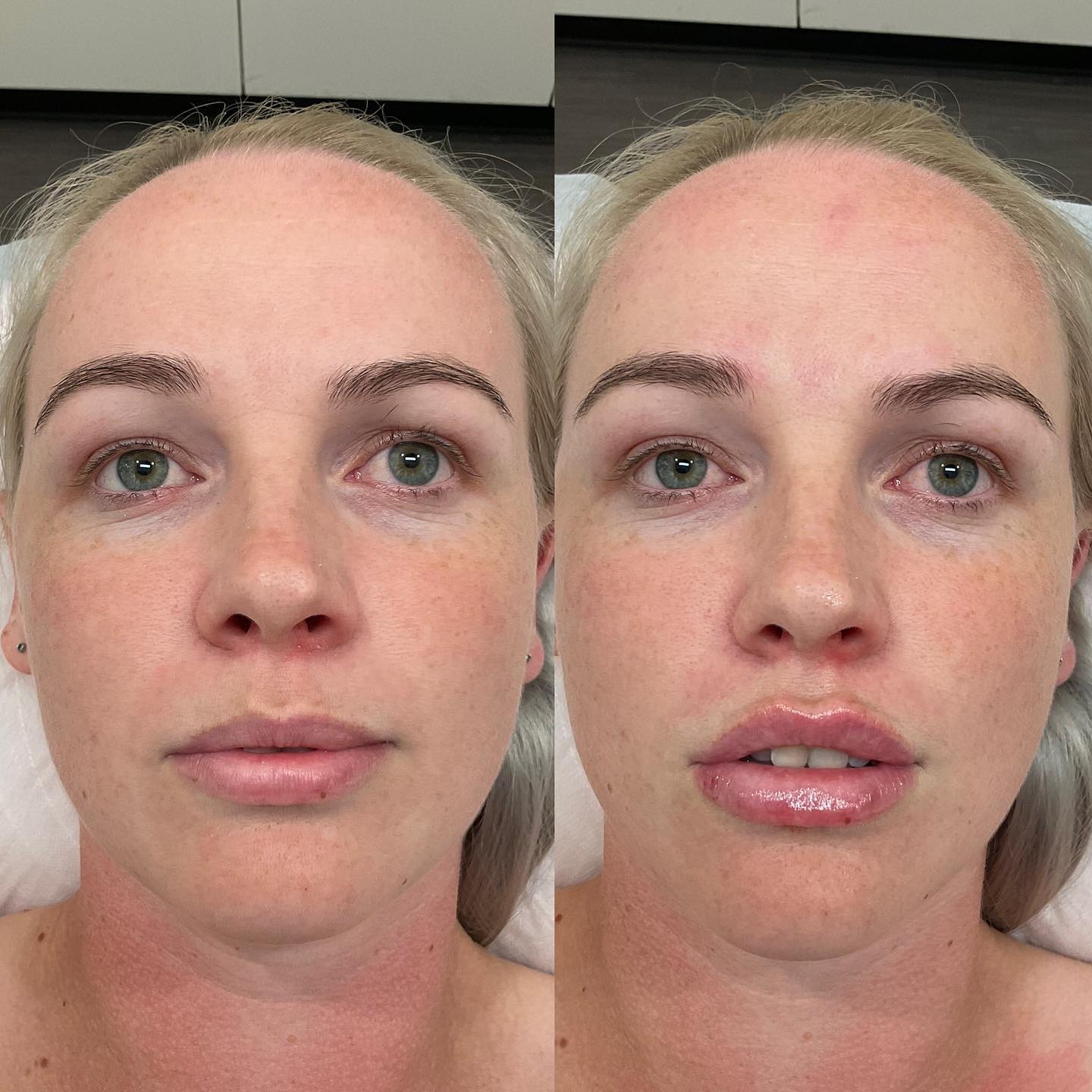 💋 Luscious from all angles 💋 1ml of... - Enhance Injectables