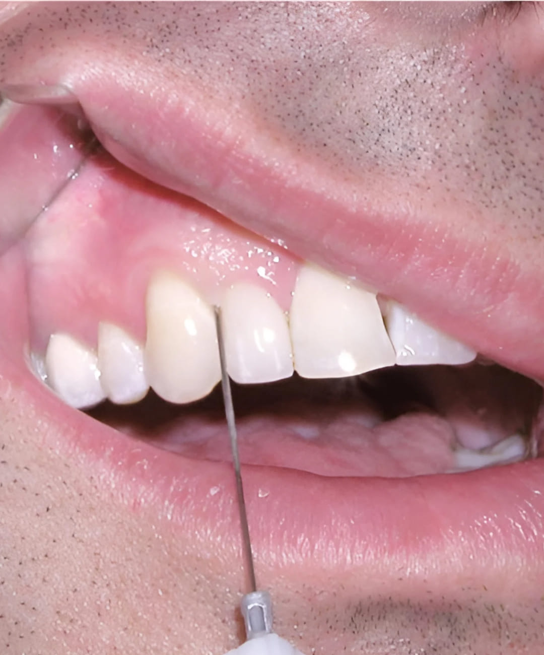 Dental - Periodontal Ligament (Intraligamentary) Injection💉 🔵The ...