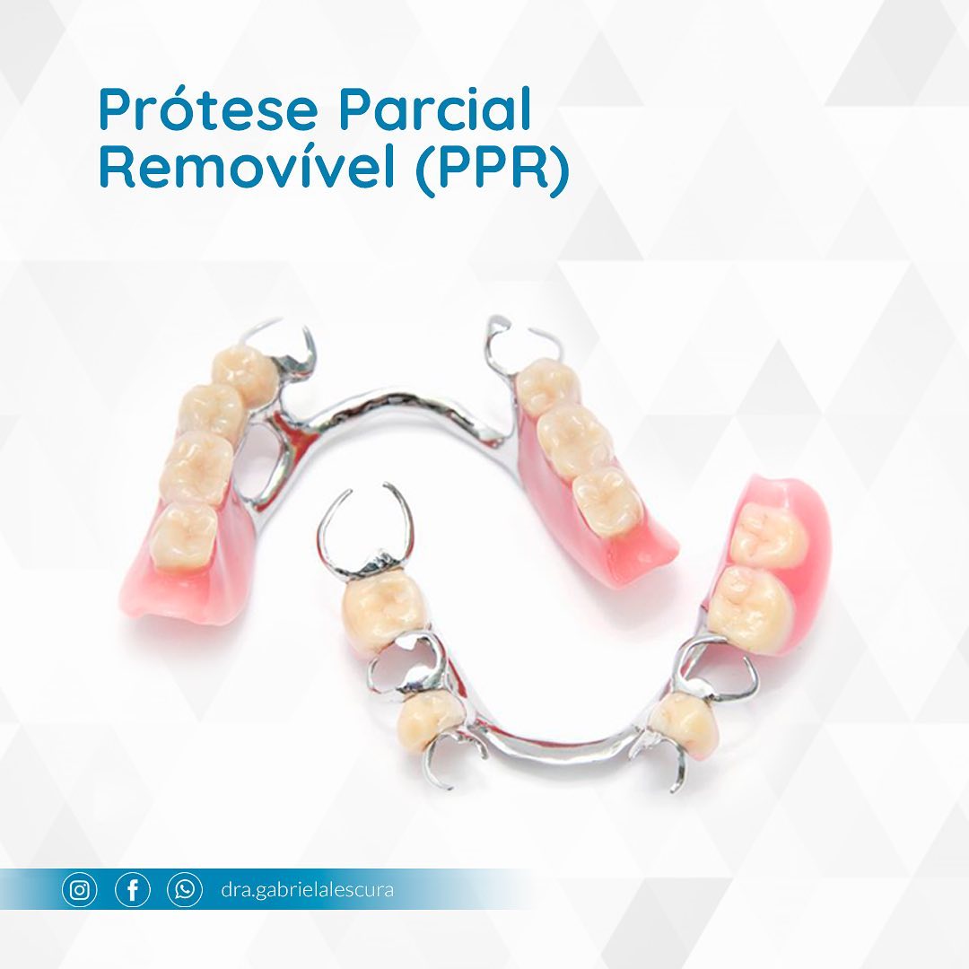 Prótese Parcial Removível (PPR)😁... - Dra. Gabriela Lescura