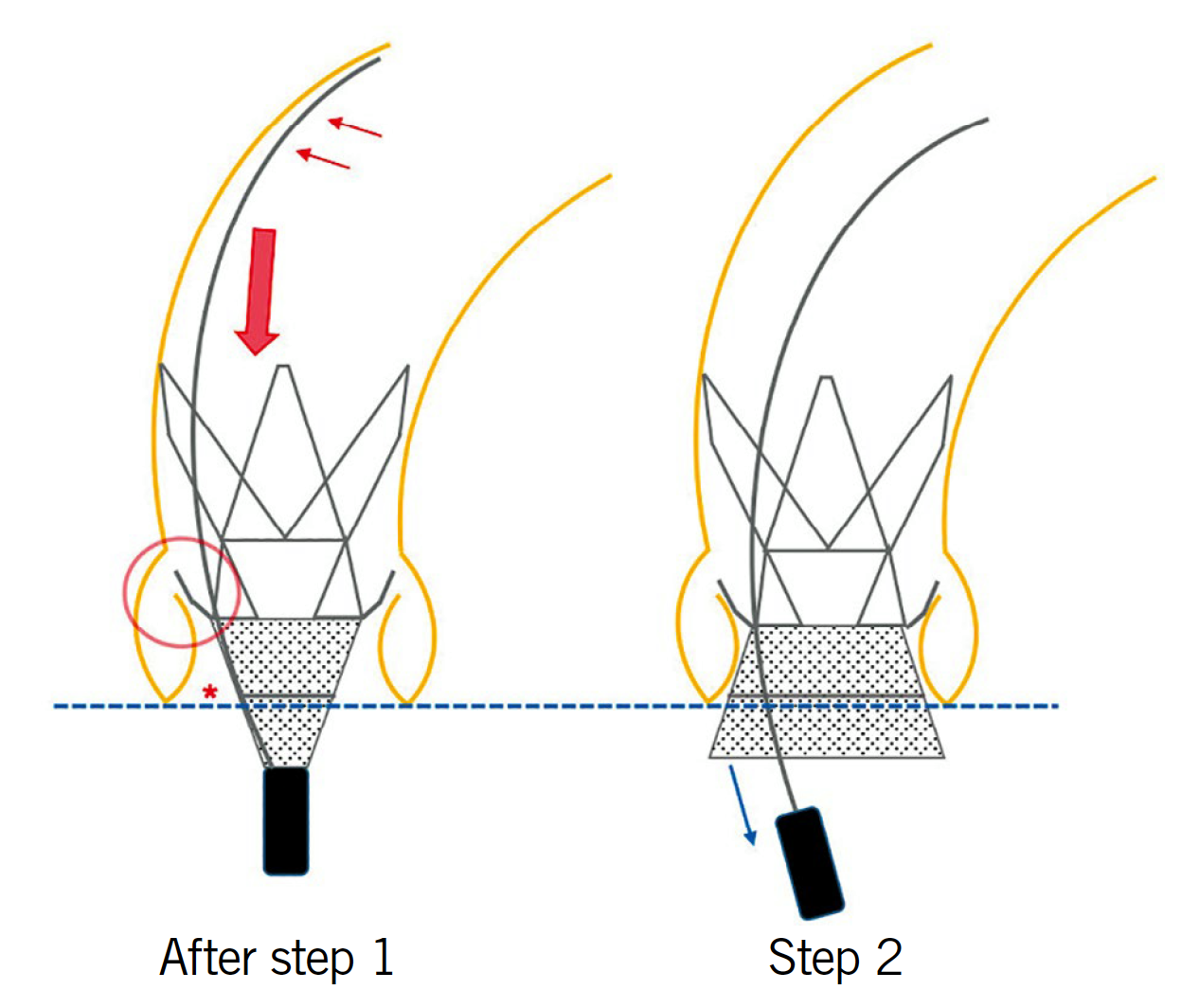 EuroIntervention - Transcatheter aortic valve implantation with the ...