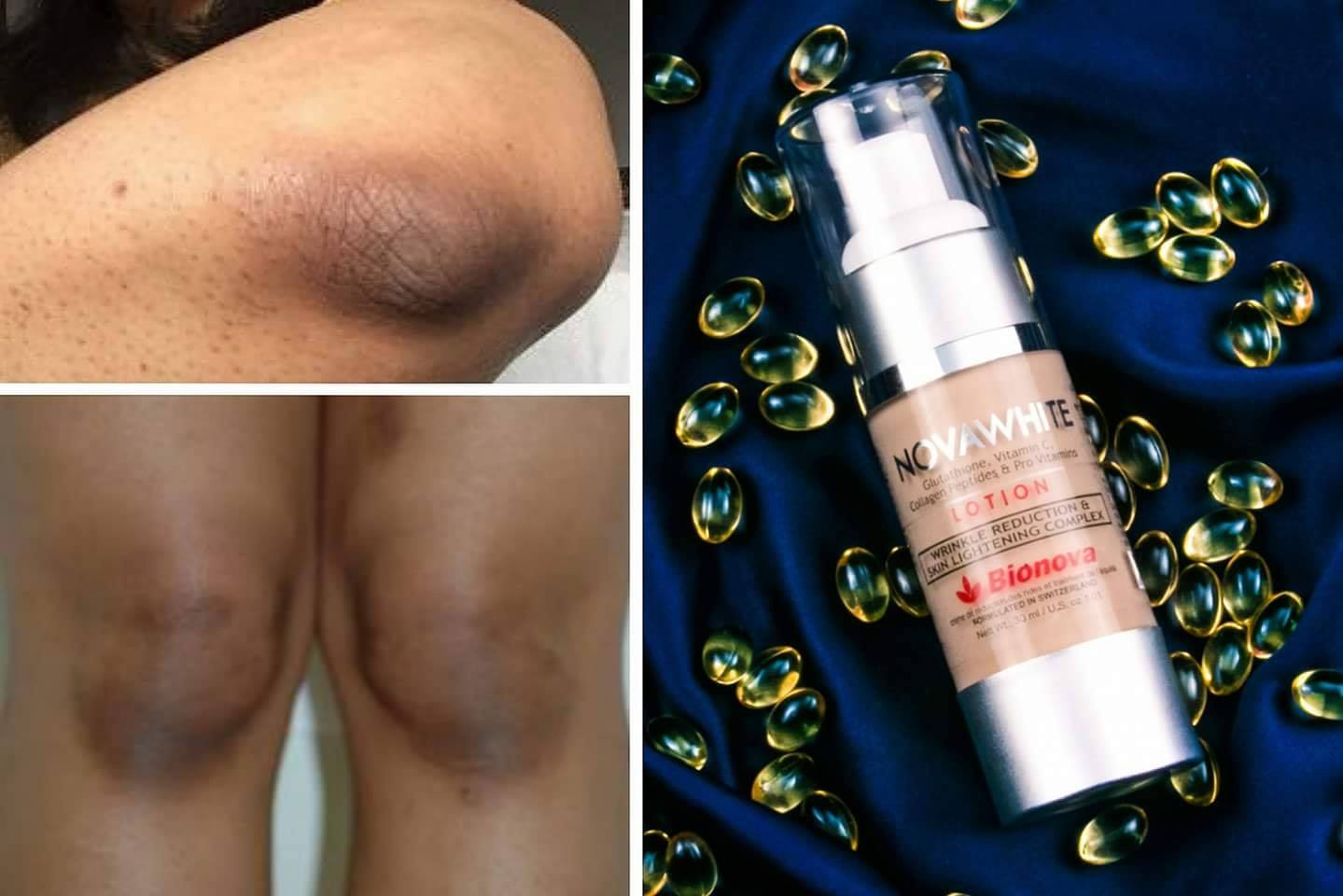 novawhite glutathione lotion reviews Bionova Malaysia Paxil Withdrawal: How To Hair Skin & Nails Dosage:10mg/10mg