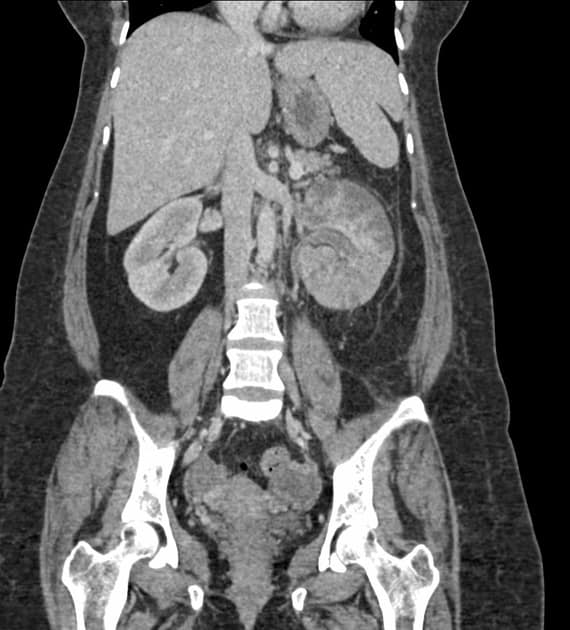 Straited nephrogram APN ATN... - Radiology Insight