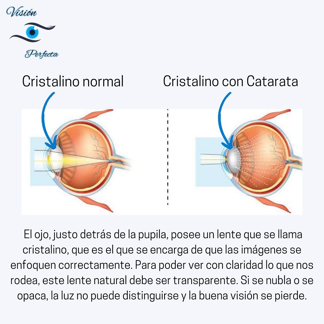 Visi Perfect - La catarata es una enfermedad visual,... | Facebook