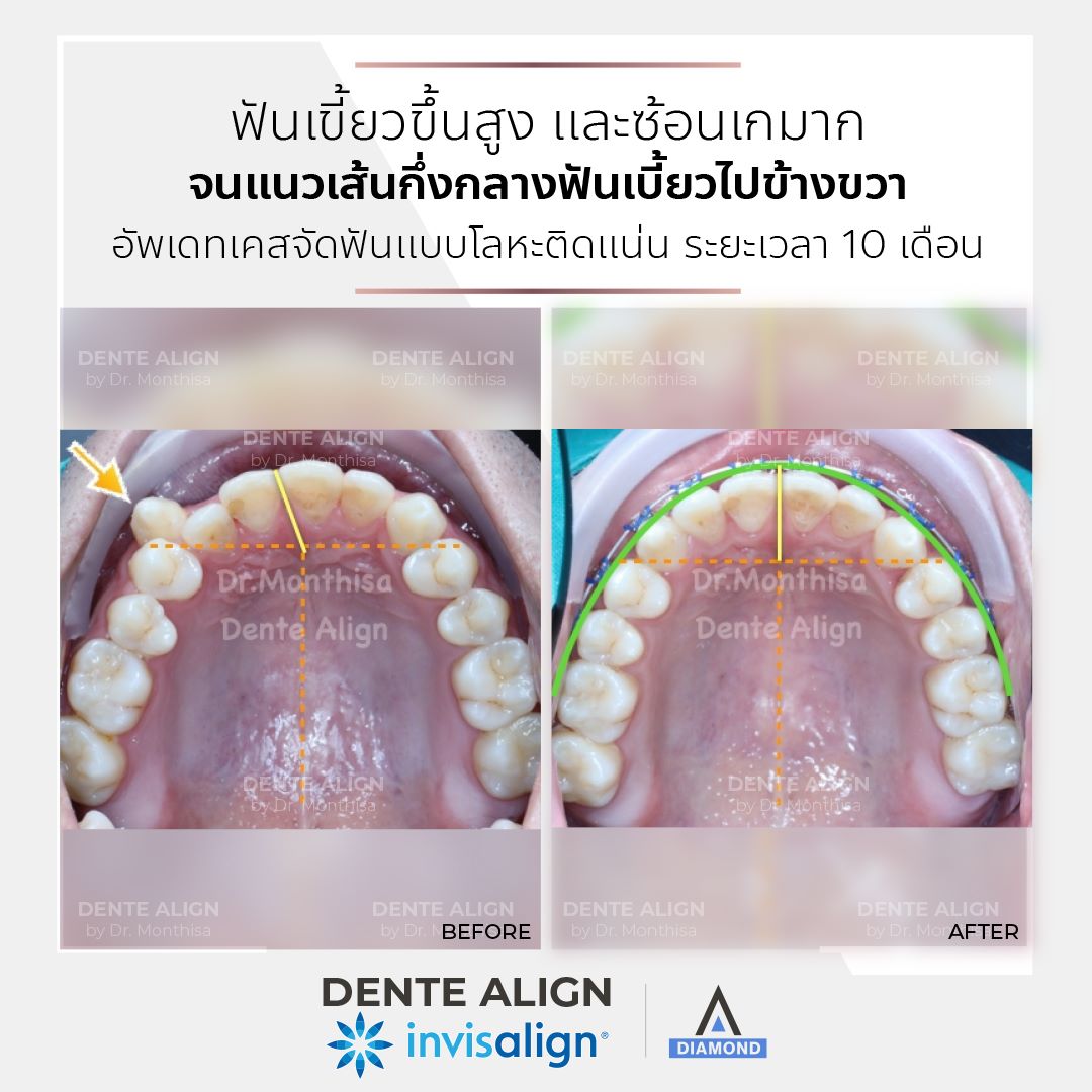 ฟันเขี้ย... - Dente Align Clinic - Invisalign Diamond Provider | Facebook