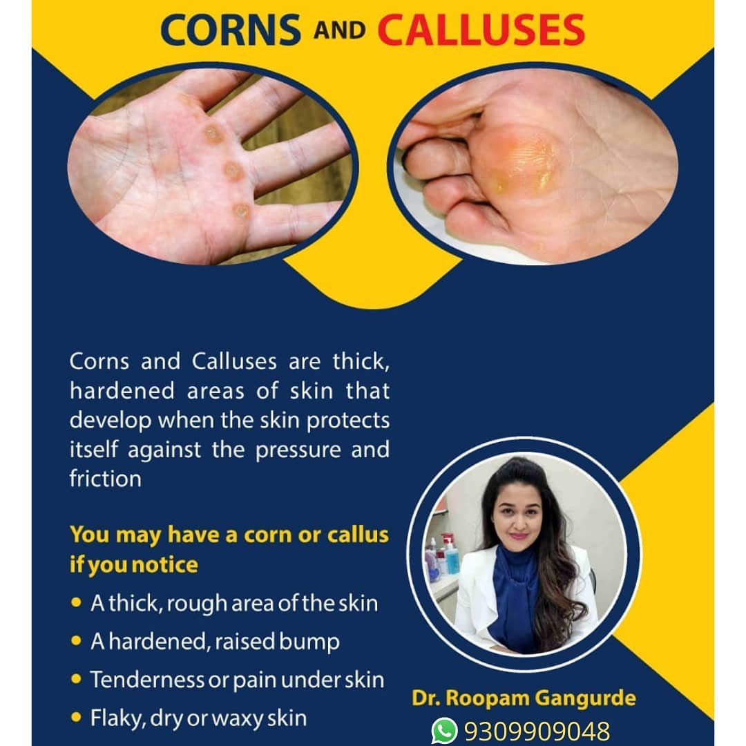 Corns is treatable..!! Corns &... - Skinacea Skin Clinic | Facebook