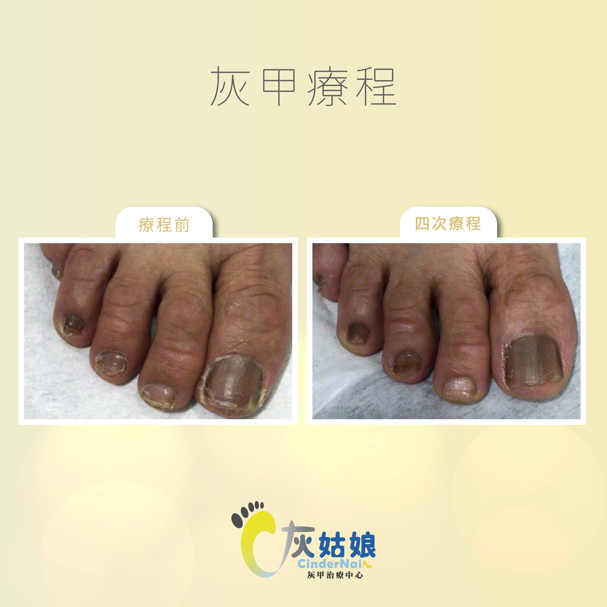 灰甲發出異味好難聞?都是因為感染到酵母菌也可能感染造成灰指甲，灰指甲... - 灰姑娘Cindernail-激光灰甲治療中心