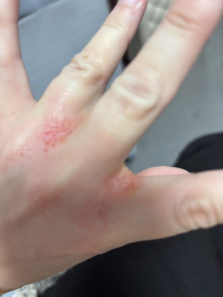 tirzepatide eczema Best Treatment in Kollam | Atopic Dermatitis GLP-1 weight loss drugs may