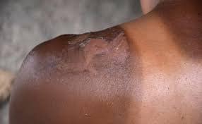 Ozempic skincare for diabetic sun sensitivity