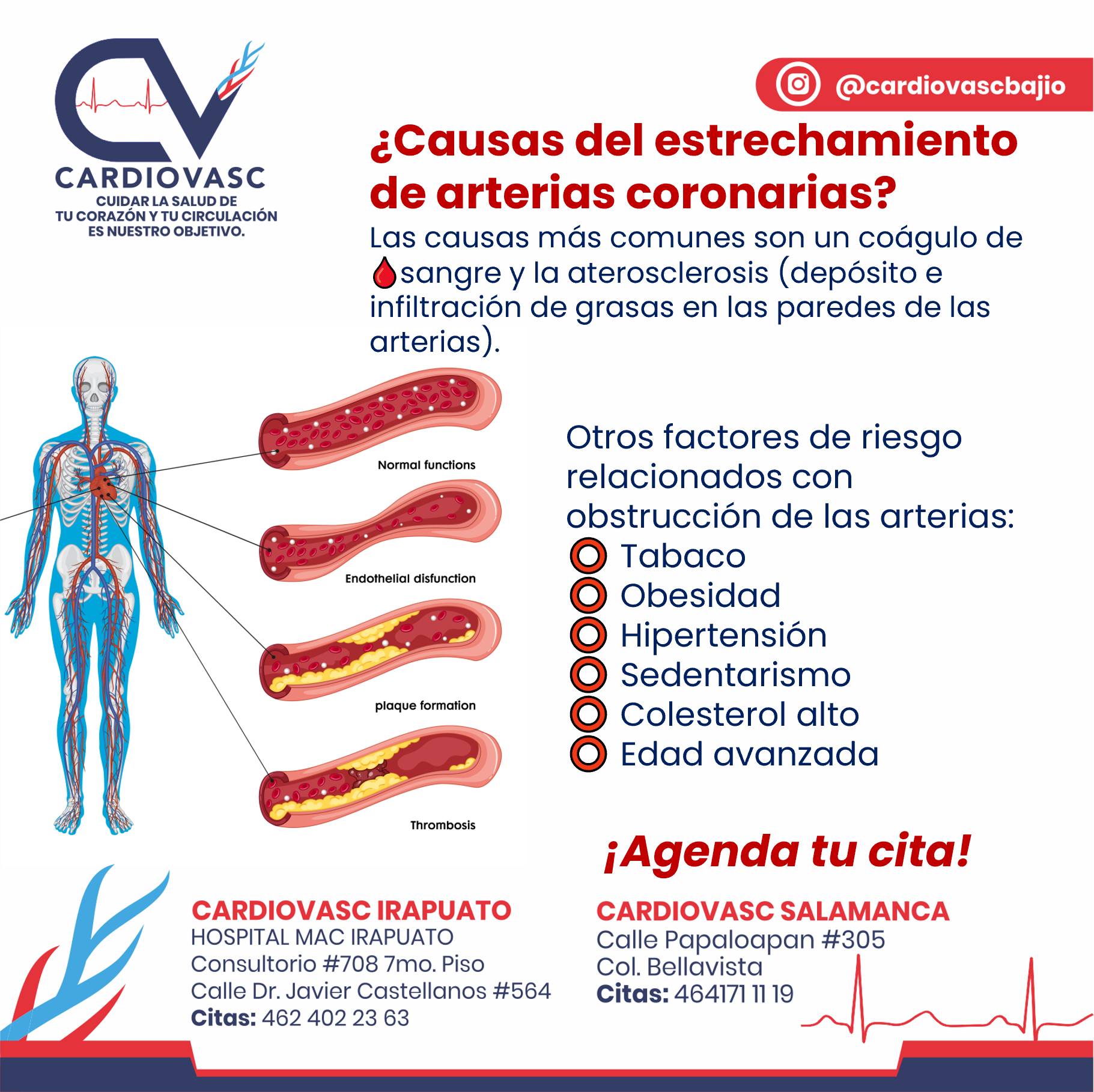 ¿Causas del... - Cardiovasc Centro Cardiovascular