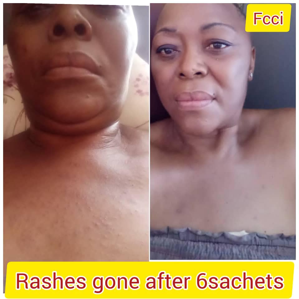 Fortune World International - FCCi skin rash testimony from South ...