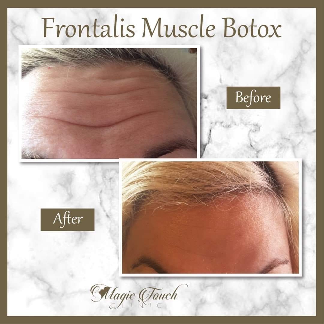 Magic Touch - Botox injections for the forehead are...