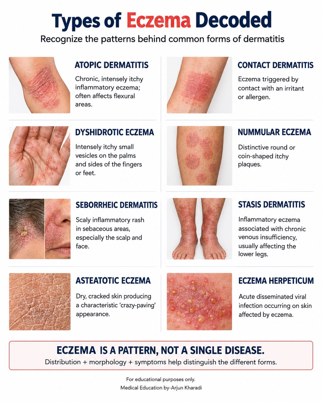 ghk-cu eczema or atopic dermatitis Types of Decoded Eczema is not a single skin condition. Common clinical types include dermatitis, contact dermatitis, dyshidrotic eczema, nummular eczema, seborrheic dermatitis, and stasis dermatitis. Although these conditions can Veterinary iron injection