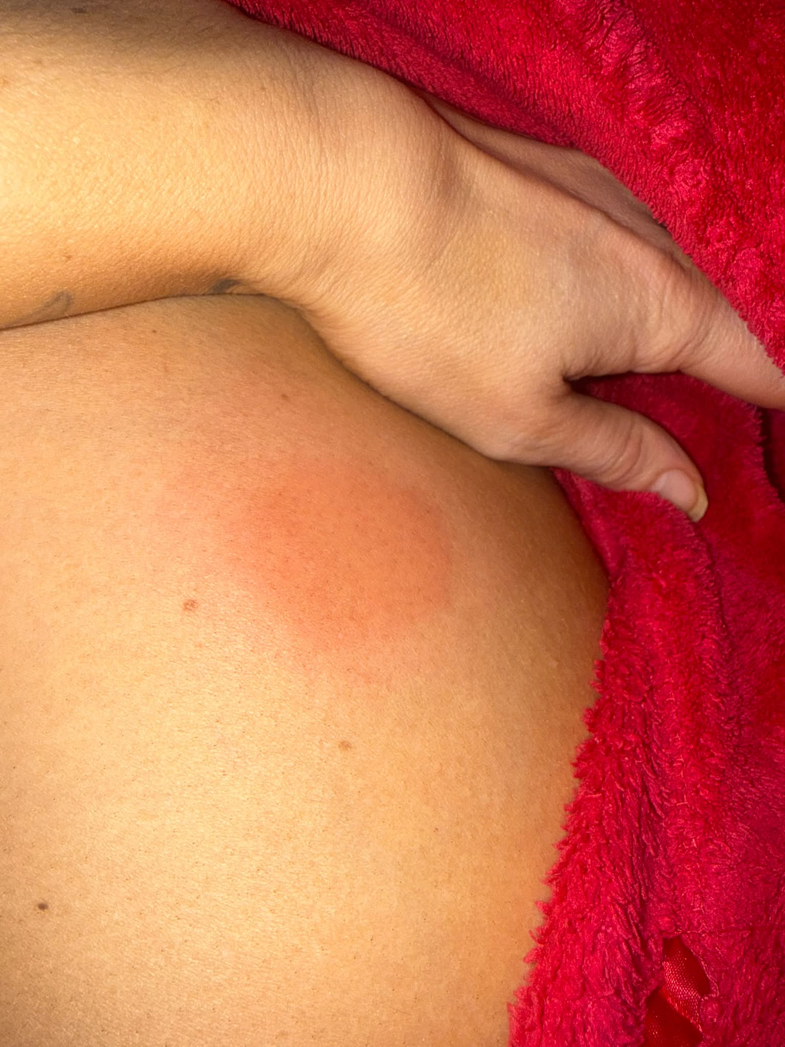 ghk-cu injection site irritation redness itching How to reduce pain from or MOTS-C injections Optimal Electrolyte (Flavor):Lemonade sermorelin and bpc 157 Cheers to PTO