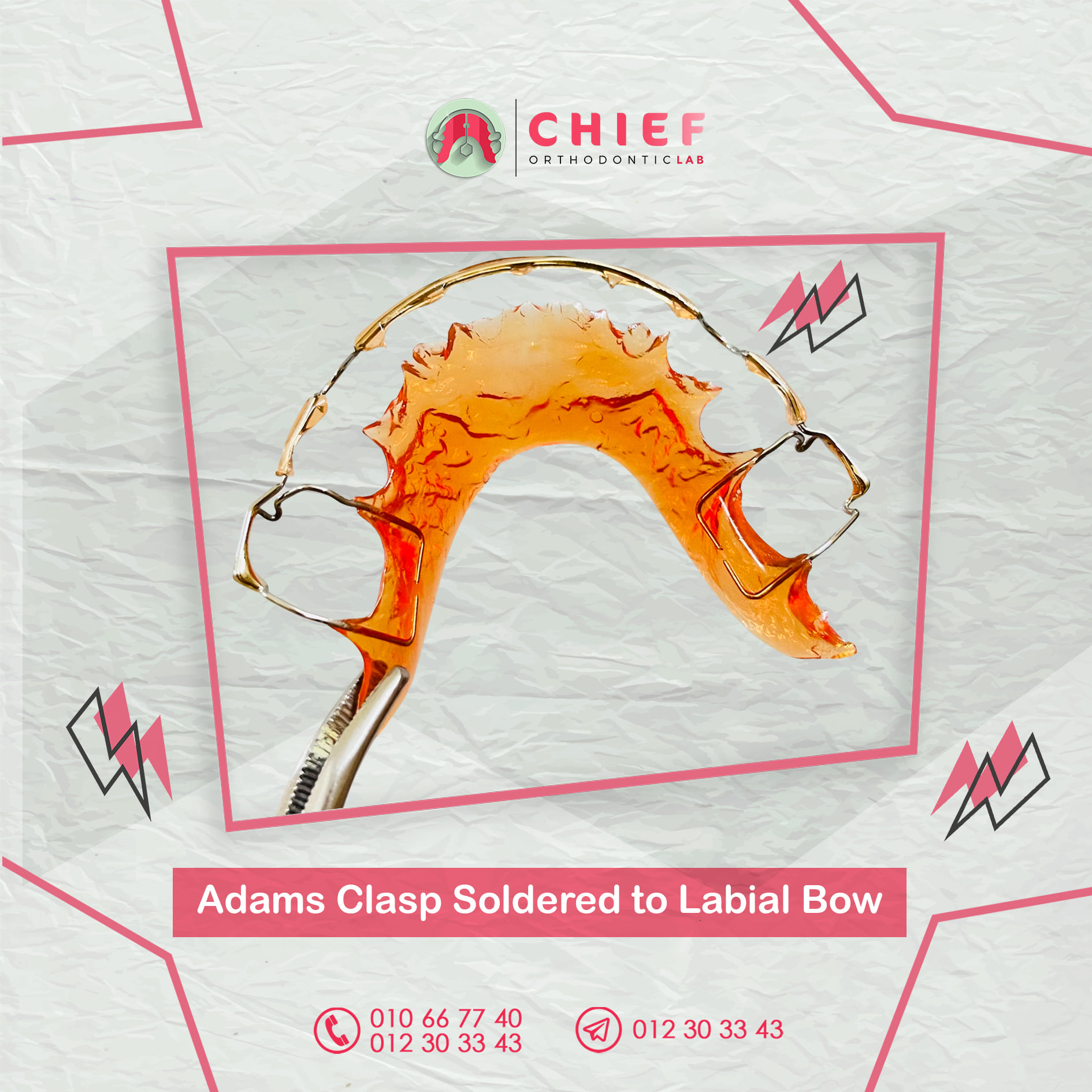 🔸 Hawley Retainers with Adams... - Chief Orthodontic Lab