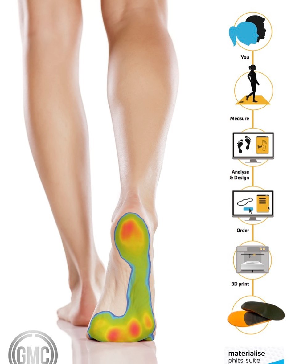 3D printed custom orthotics using the... - Hove Foot Clinic | Facebook