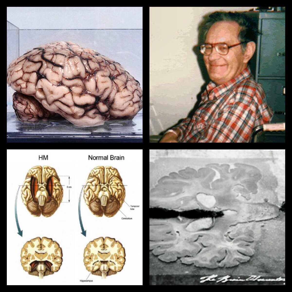Henry Gustav Molaison (h. M.) Had Brain Surgery For Which