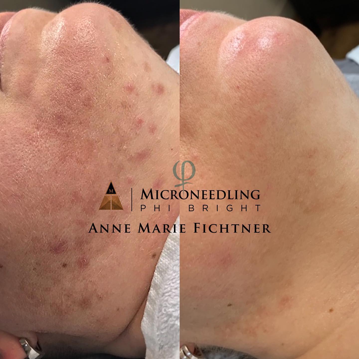PHIBRIGHT 💙 Bei Hyperpigmentierung... - annemariefichtner | Facebook