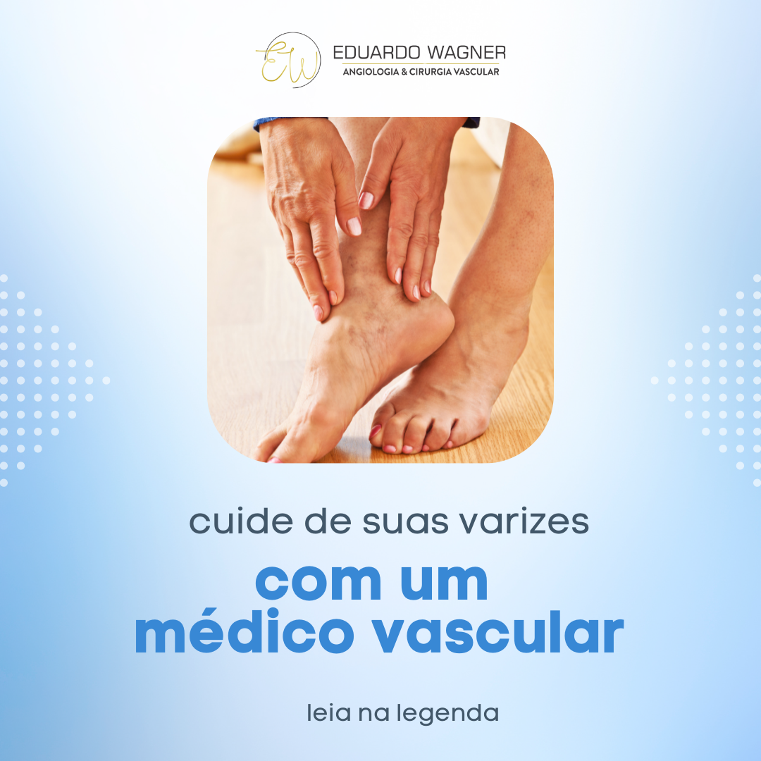 Dr. Eduardo Wagner Marques - As varizes são veias dilatadas e tortuosas ...