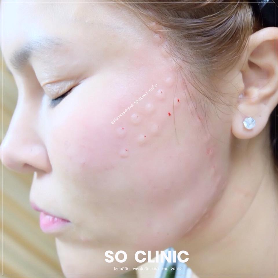 BOTOX FILLER MESO - Dermolift Korea Buffet ⠀⠀⠀⠀⠀⠀⠀⠀⠀⠀⠀⠀⠀⠀⠀⠀⠀⠀⠀⠀⠀ • เป็น ...