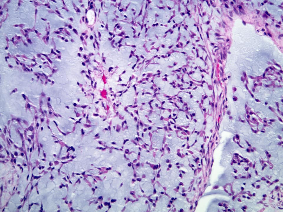 1. I have a low mag pattern that... - Sanjay Mukhopadhyay, MD | Facebook