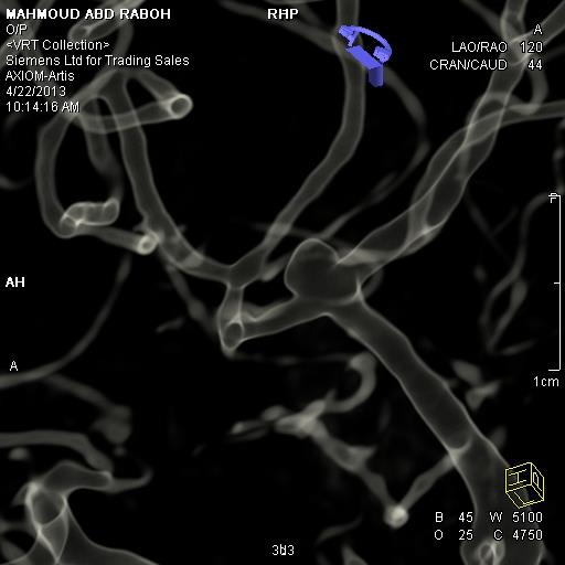 Interventional neuroradiology Coiling of Intracranial aneurysm