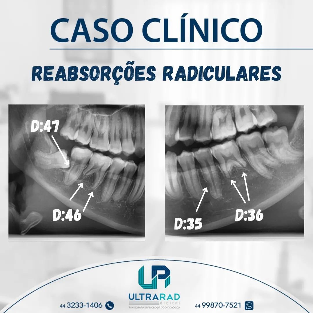 🦷 REABSORÇÕES... - Ultrarad - Radiologia Odontológica Digital
