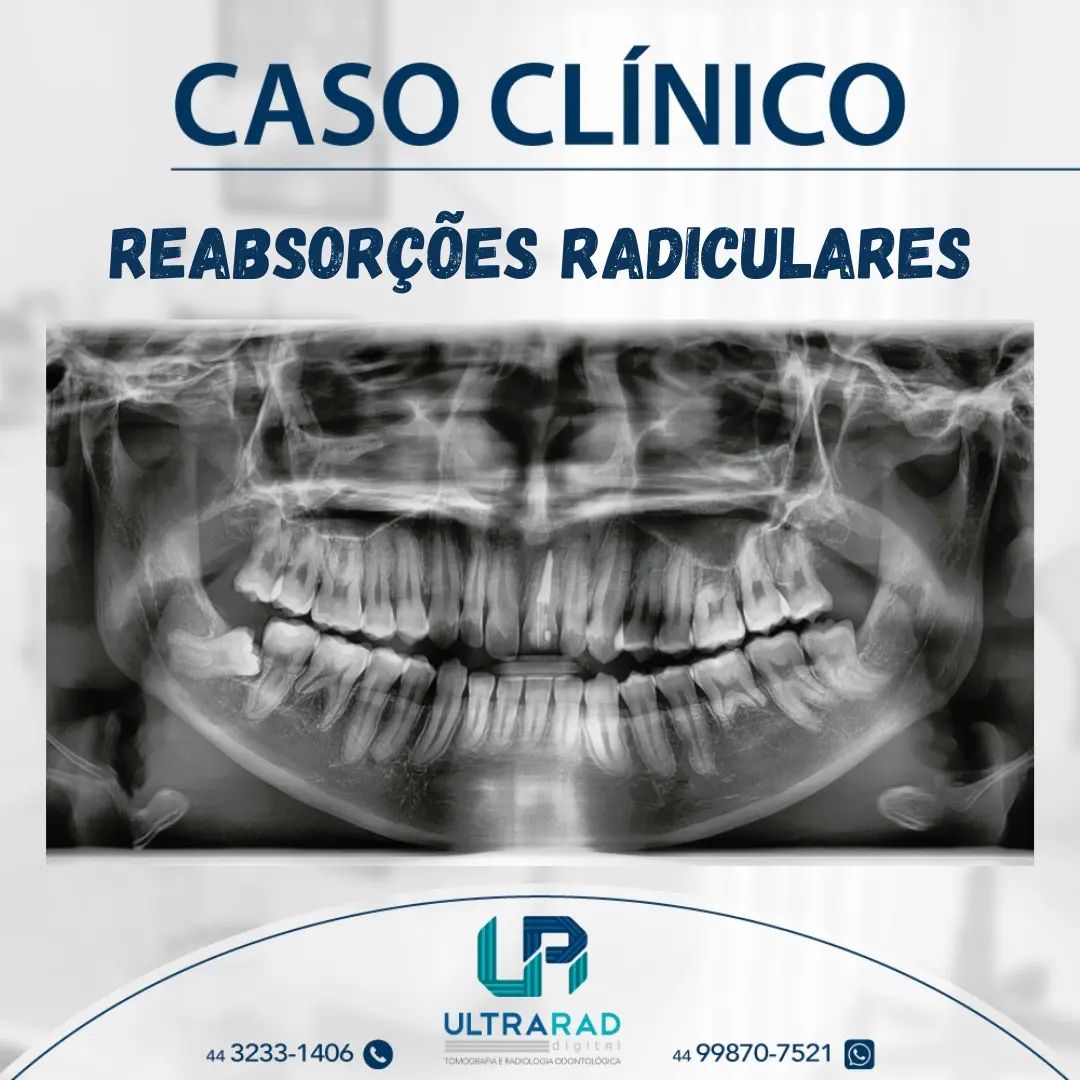 🦷 REABSORÇÕES... - Ultrarad - Radiologia Odontológica Digital