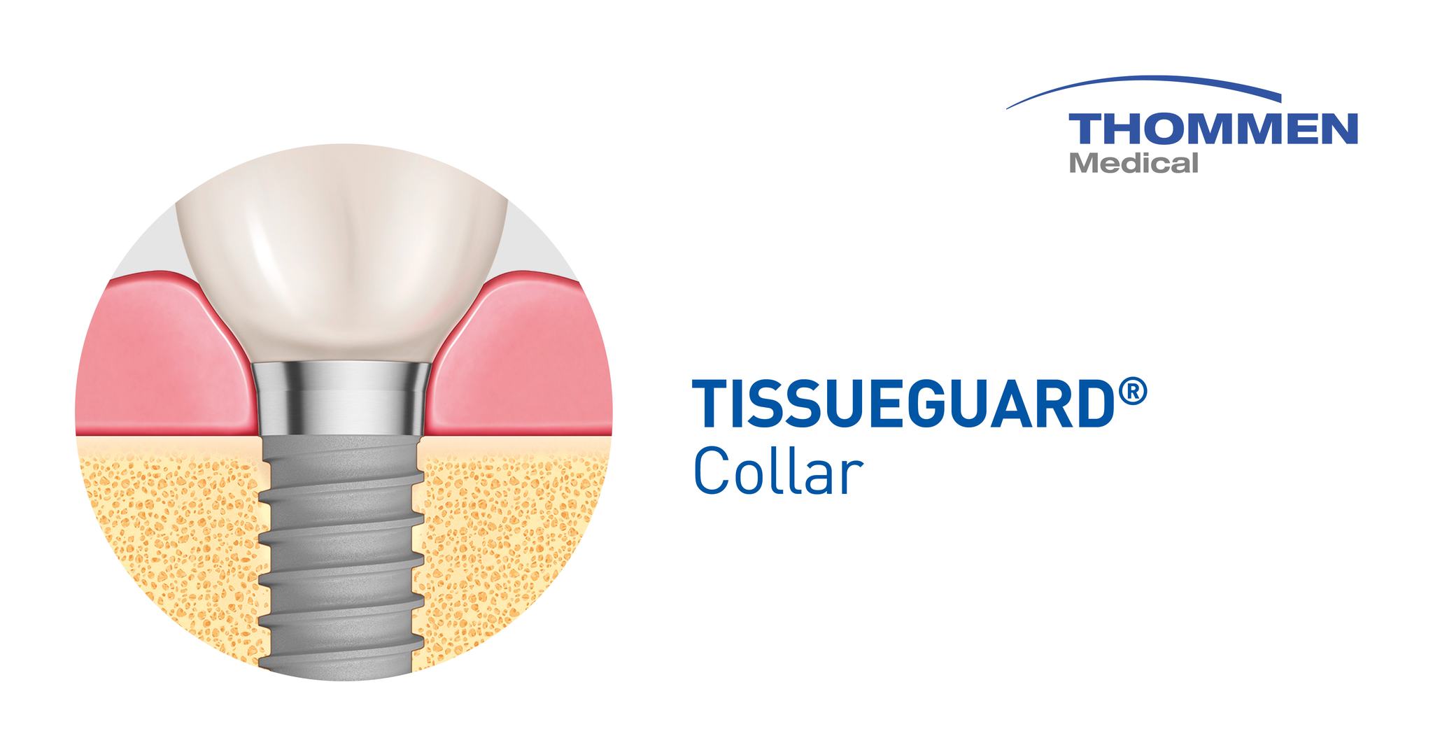 Thommen Medical - TISSUEGUARD® Collar - Did you know?... | Facebook
