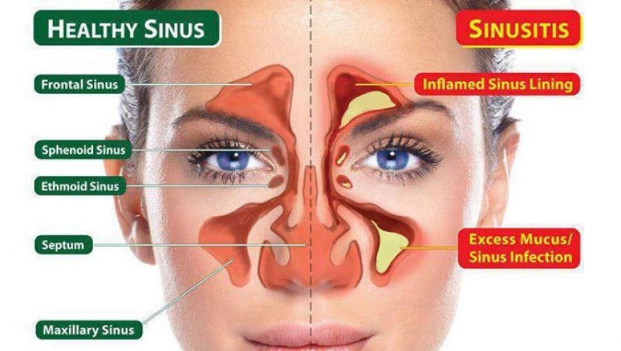 Kapi za sinuse - Sinusitis STOP