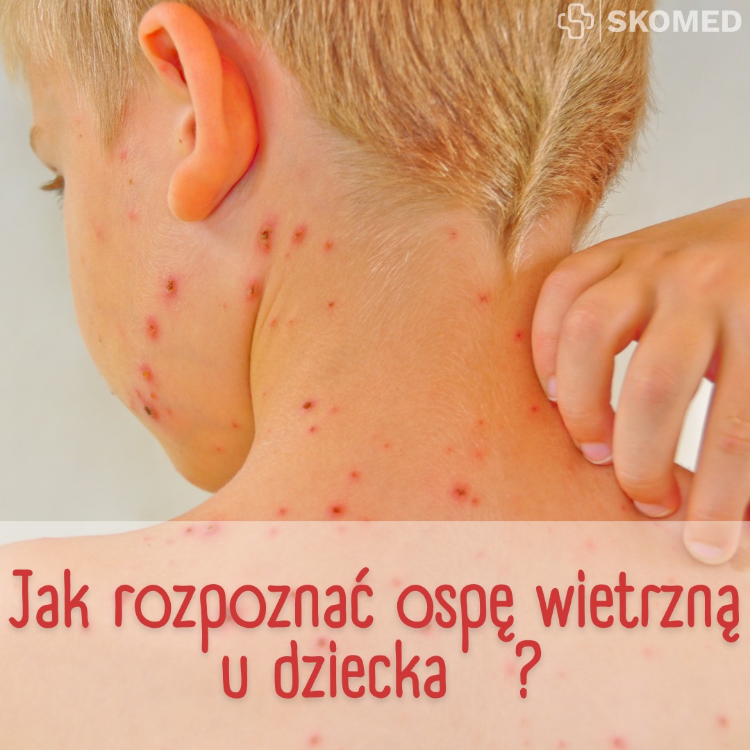 🩺 Jak rozpoznać ospę wietrzną u... - Przychodnia Skomed