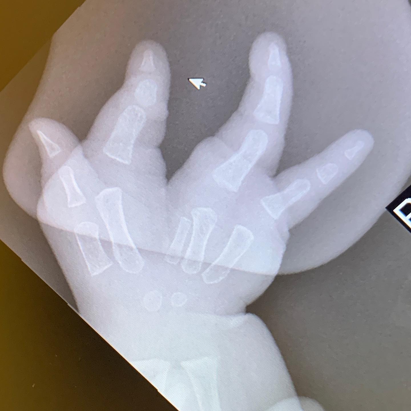Congenital Hand and Arm Differences