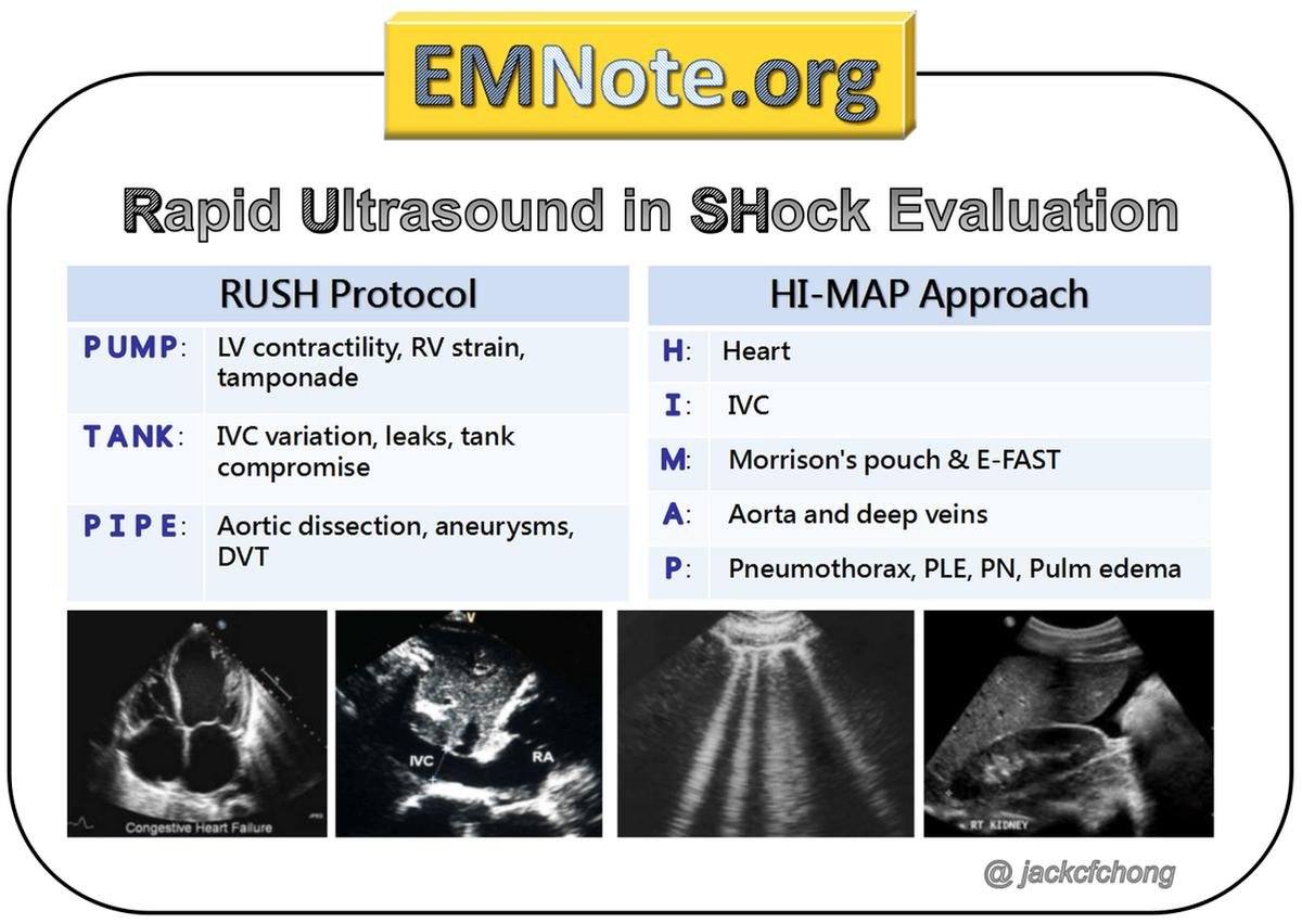 Caduceus EM & Critical Care FOAM | 🩺POCUS 🩺HI-MAP 🎯Heart 🎯IVC 🎯Morrison ...