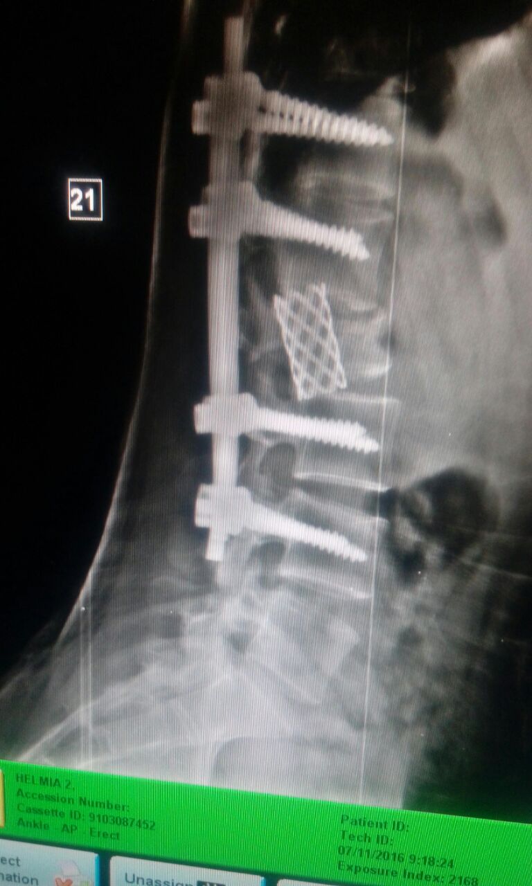 Helmia spine surgery