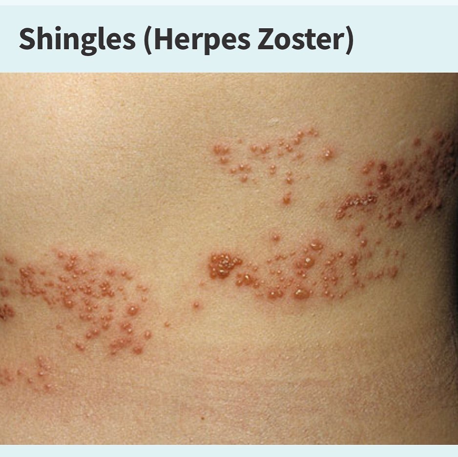 Amer Skin Care - A rash of raised dots that turns into... | Facebook