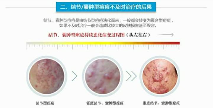 结节囊肿型痘痘脸上长结节囊肿痘的进分享 第二人生