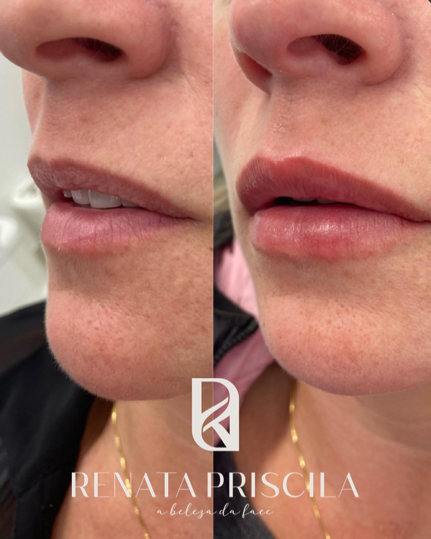 1ª foto: Labio Cicatrizado (pós 15... - drarenatapriscila | Facebook