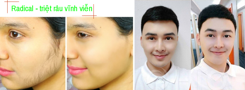 Radical - Triệt Râu Lông Chính Hãng | Hai Phong