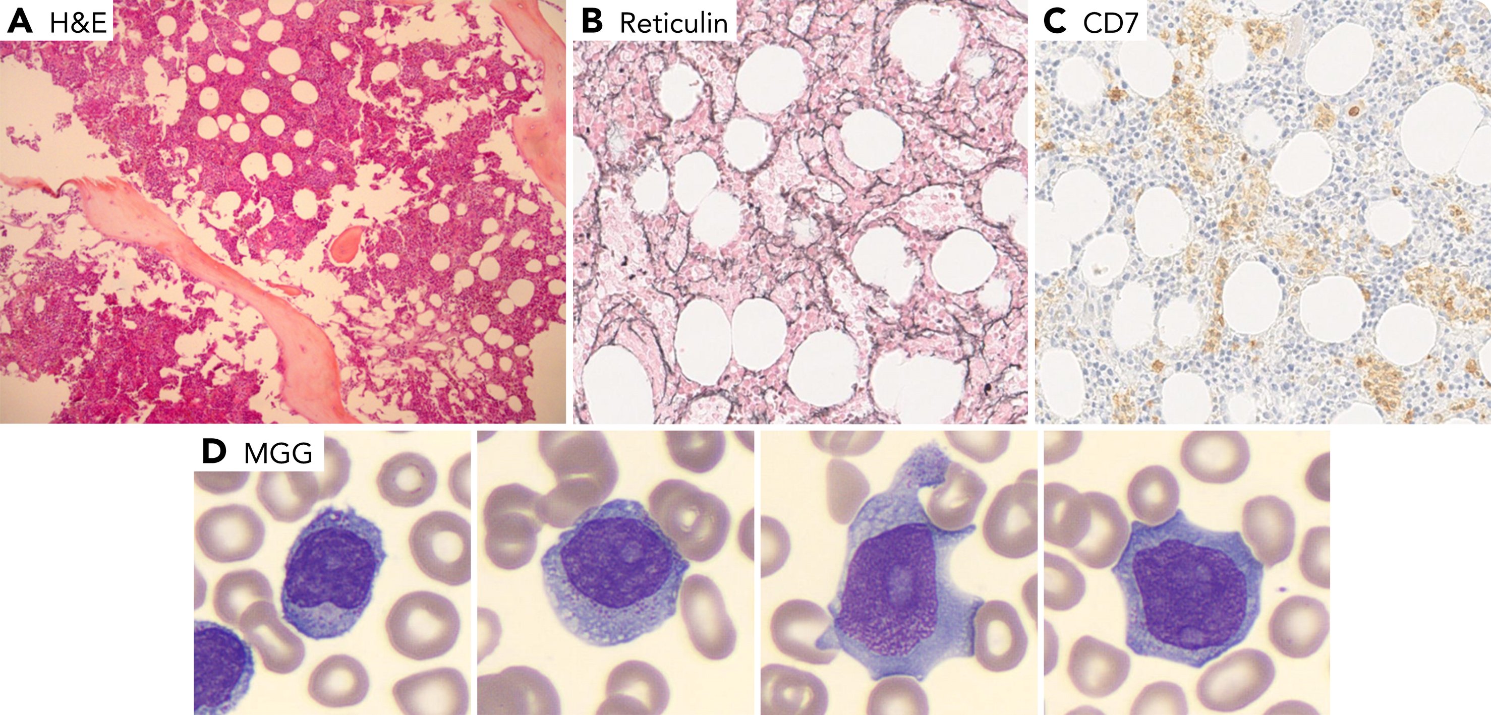 An unusual myelofibrosis A... - Blood and Hematology