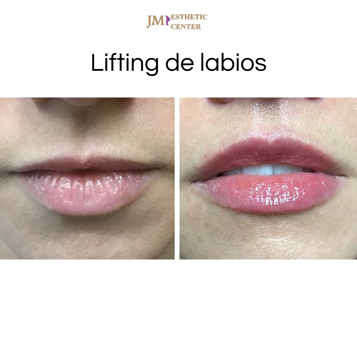 Jmcentroestetico - Recupera la anatomía de tus labios.👄 ¿Sientes tus ...
