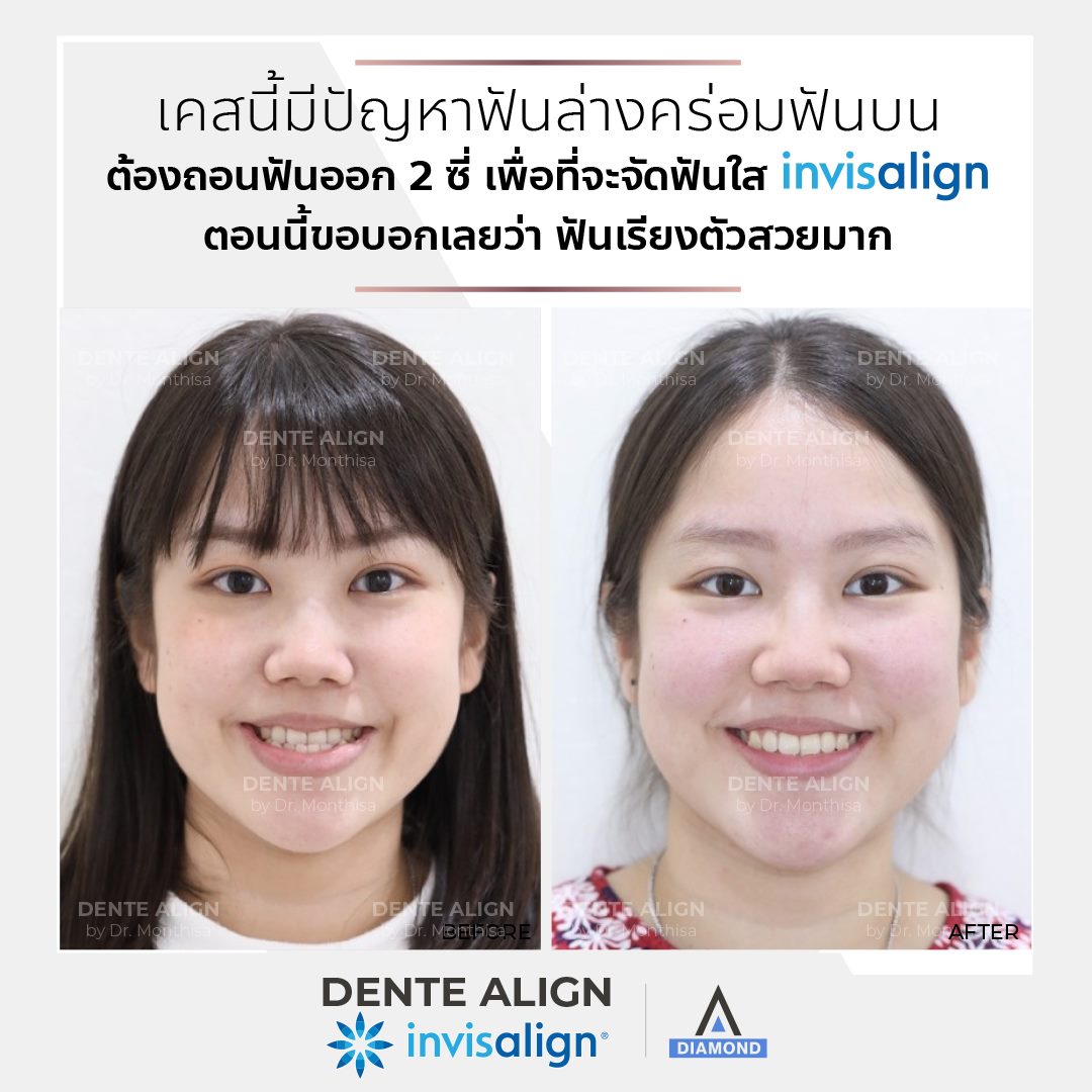 เคสนี้มี... - Dente Align Clinic - Invisalign Diamond Provider | Facebook