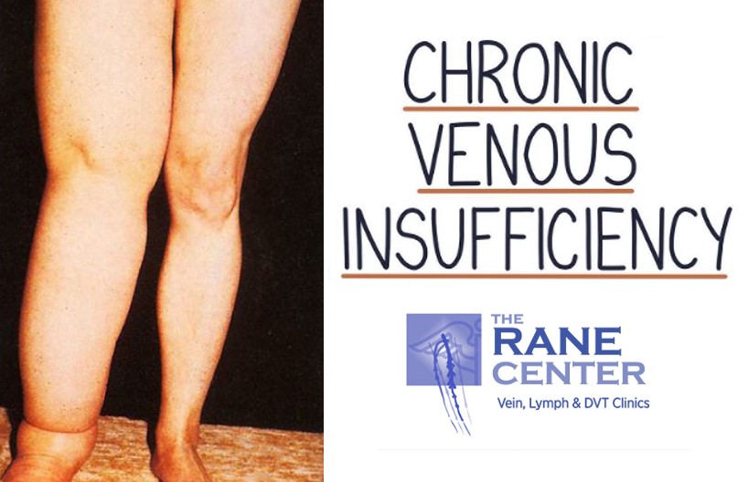 The Rane Center - Vein problems are among the most common chronic ...